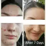 Serum for acne before & after